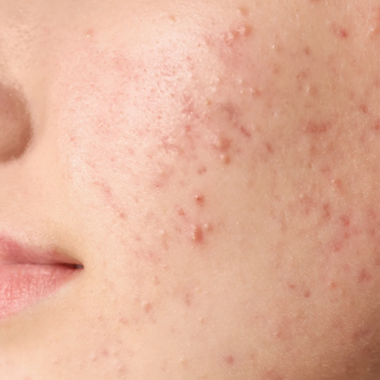 Akne mit Pickeln