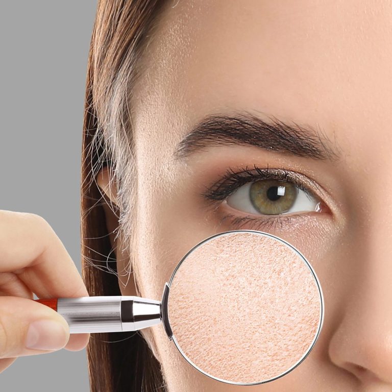 Unreine haut Akne haut